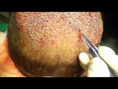 Hair Transplants Surgery in Punjab | Delhi Hair Clinic