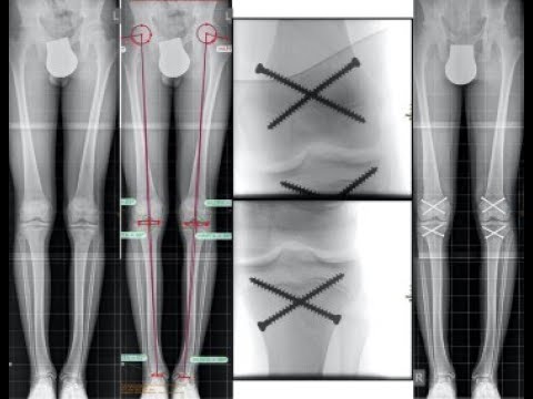 Epiphysiodesis; orthopedic surgical procedure to halt growth at growth plate physis in long bone