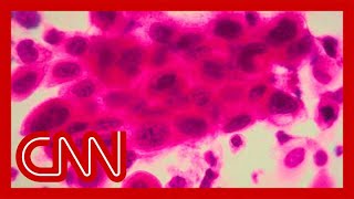 Download lagu 'Tumors just vanished': Cancer patients now in remission after drug trial mp3