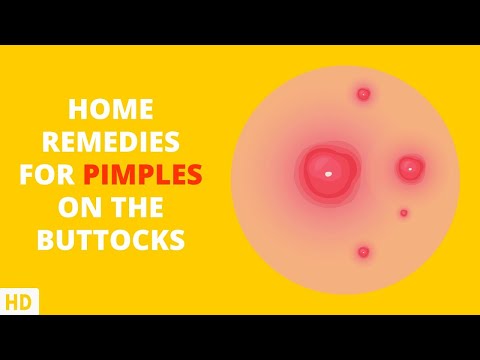 Booty Breakouts No More: Effective Home Remedies for Pimples on Your Butt
