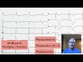 ECG Quickie AV Block