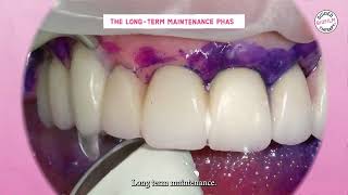 Implant Maintenance with GBT I GBT Microlearning with Prof. Ioannis K. Karoussis