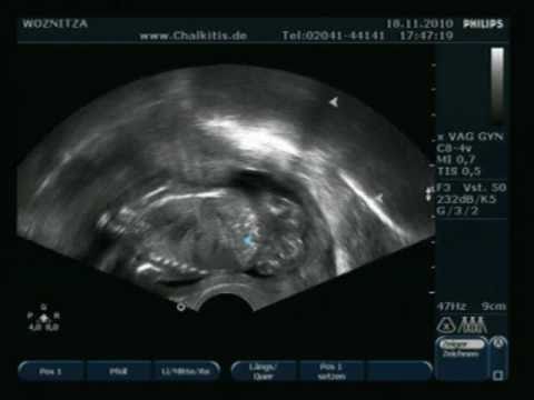 Osteochondrose der Arteria vertebralis Syndrom Osteochondrose des Cervical-BWS ICD