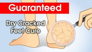 Dry Cracked Feet? How to cure.