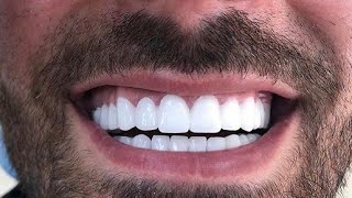 سناب اون سمايل وجدة snap on smile Oujda