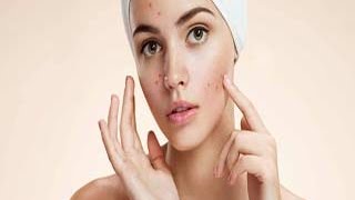 Natural Home Remedies to Remove Deep Acne Marks