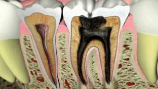 Endodontics - What Causes a Tooth Ache