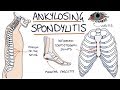Spondylitis Ankylosans Visuelle Erklärung Für Studenten