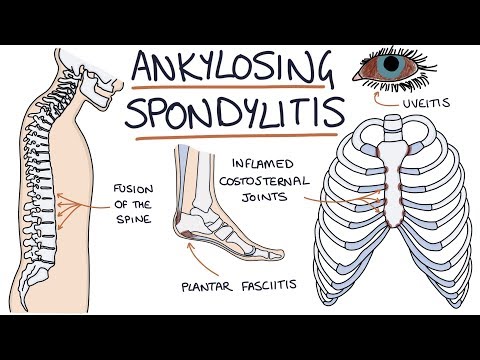 Férgek és spondylitis ankylopoetica