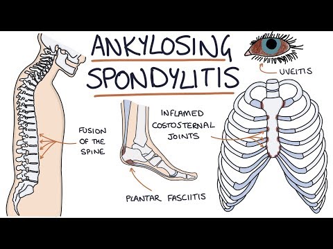 helmintikus terápia ankylopoetikus spondylitis