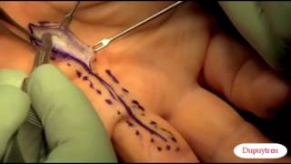 Dupuytren Fasciectomía