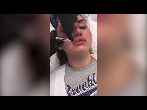 Dr. Natalie Keller – Lippenformung to go mit Hyaluronsäure in Osnabrück