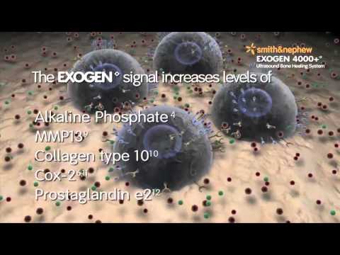 Exogen Bone Stim