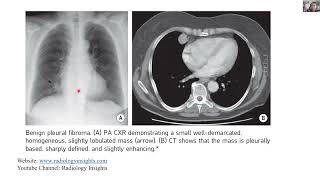 Resp 2.2 Localized Fibrous Tumor