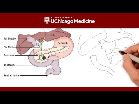 What is the Whipple procedure? - UChicago Medicine