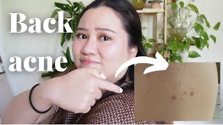 How I got rid of my BACK ACNE FAST! 😱 Before/After Pics!