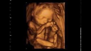 Download lagu 3d/4d Ultrasound AT 23 Weeks from GoldenView Ultrasound mp3 Download lagu 3d/4d Ultrasound AT 23 Weeks from GoldenView Ultrasound mp3
