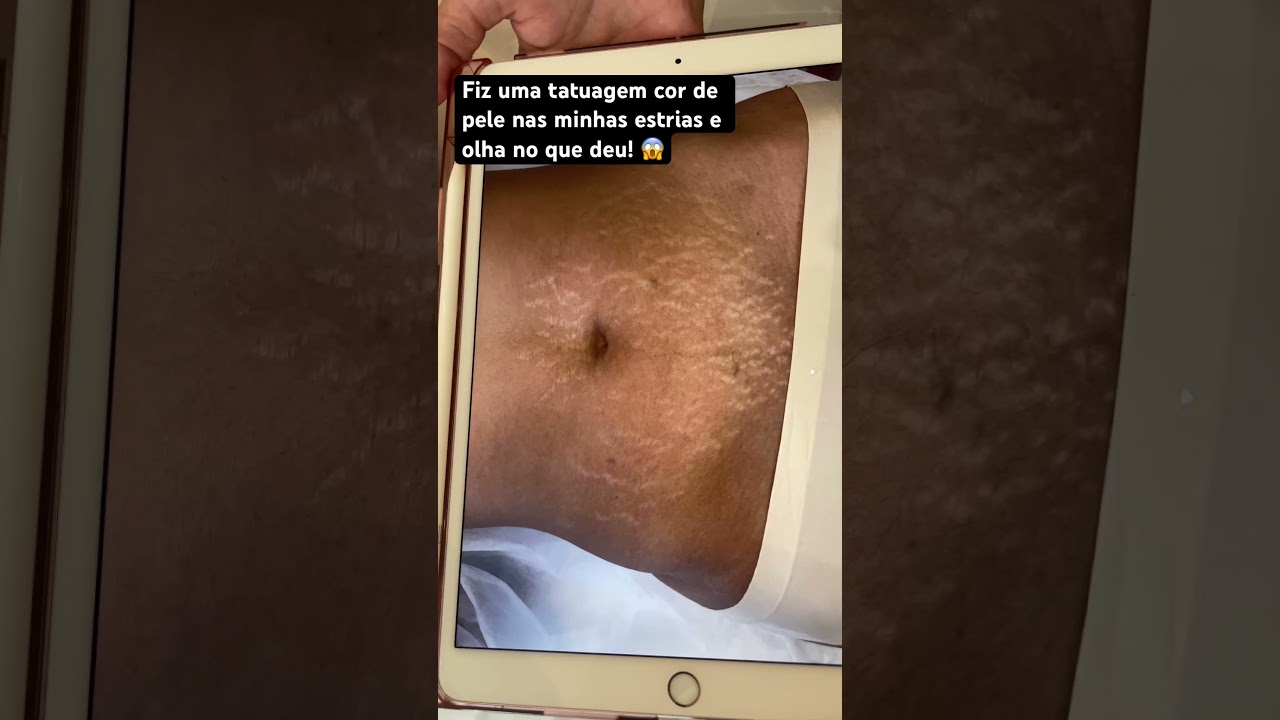 Tatuagem Estética Cor De Pele | Para Cobrir Estrias