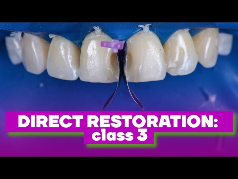 Direct Restoration: Class III - Clinical Case
