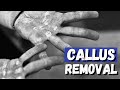 Hand Callus Removal | Get Rid of that Hard and Rough Skin! Hand Callus Removal | Get Rid of that Hard and Rough Skin!