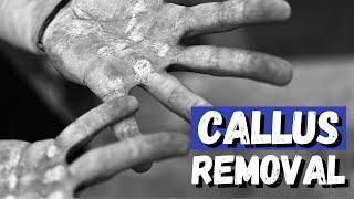 Hand Callus Removal | Get Rid of that Hard and Rough Skin!