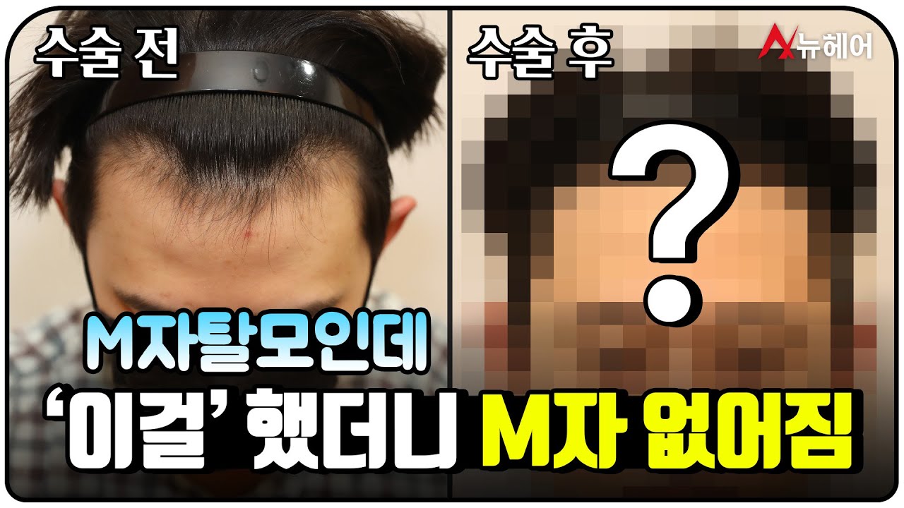 M자탈모인데 '이 방법'으로 해결했습니다ㅣ뉴헤어