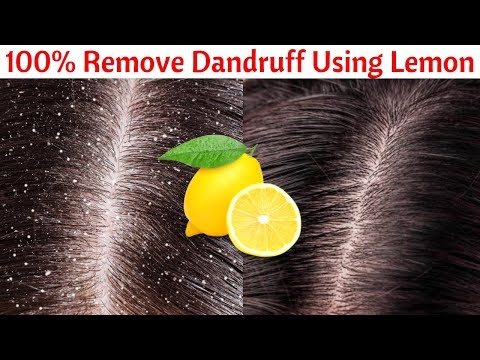 download lagu mp3 mp4 Remove Dandruff With Lemon, download lagu Remove Dandruff With Lemon gratis, unduh video klip Remove Dandruff With Lemon