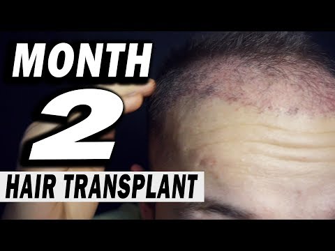 download lagu mp3 mp4 Hair Transplant 2 Months, download lagu Hair Transplant 2 Months gratis, unduh video klip Hair Transplant 2 Months