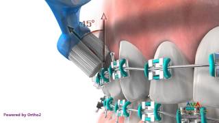 preview picture of video 'Brushing while in Braces - Orthodontic Instruction'