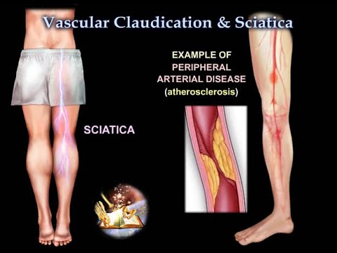 Claudicación vascular o ciática - Todo lo que debe saber