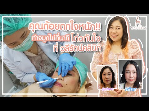 ร้อยไหม