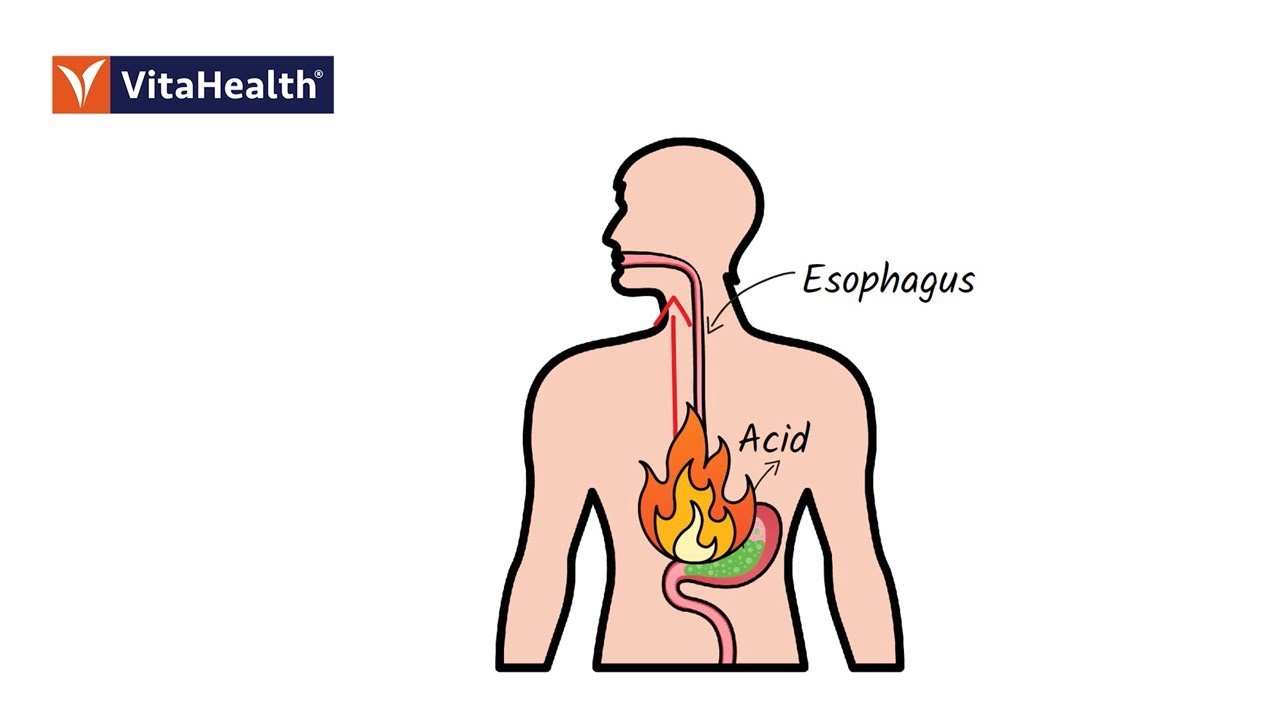 Have You Ever Experienced the Burning Sensation in Your Chest?
