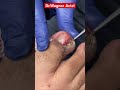 A DINOSAUR INGROWN TOENAIL REMOVAL Shorts
