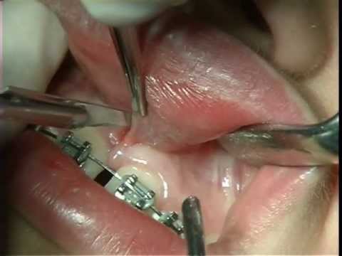 download lagu mp3 mp4 Diastema Op, download lagu Diastema Op gratis, unduh video klip Diastema Op