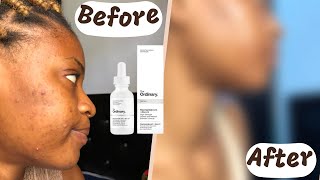 I Tested the Ordinary Niacinamide and Zinc serum EVERYDAY for 30 Days|This happened…