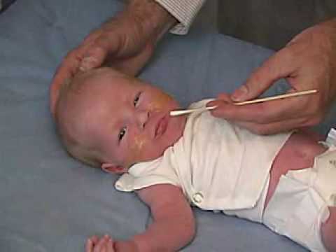 neurology exam: newborn-abnormal: Primitive Reflexes - Suck, Root