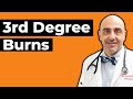 Third Degree Burn: Symptoms and Treatment