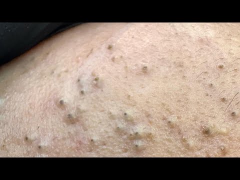 Dermatologist's Daily Skincare Routine for Clear Skin