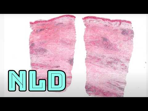 NLD Necrobiosis Lipoidica Diabeticorum (firm yellow-red-brown skin on shins in diabetes) dermpath