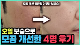 다른 방법으로 모공 실패한 분들만 오세요