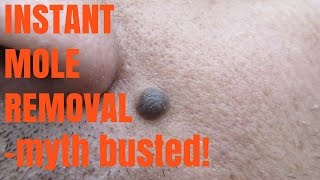 Instant Mole Removal-myth busted