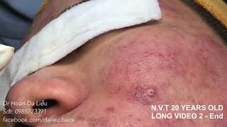 Dermatologist treating squeeze pimples,whitehead blackhead, pustule,anti acnes|N.V.T 20 Long video 2