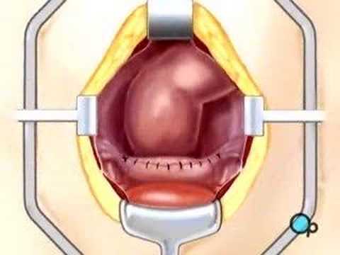 PreOp® Patient Education:  Hysterectomy Removal Uterus 2