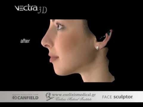 Rhinoplasty 3D simulation www.exelixismedical.gr   .wmv