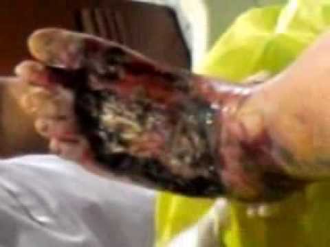 VIDEO Akupunktur untuk Diabetes terapis Oei Gin Djing 