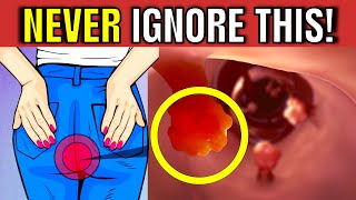 7 Warning Signs of Colon Cancer You Should NEVER Ignore!
