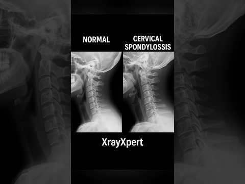 Cervical Spondylosis vs Normal Spine – Dekhiye X-ray me fark! #cervicalstenosis #diskbulge #spine