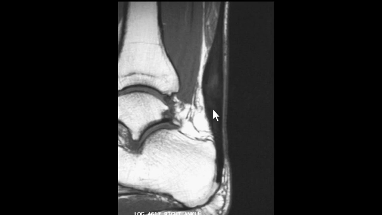 Tendinose / Tendinopatia.