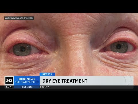 Recenly approved FDA technique proving good treatment for dry eyes