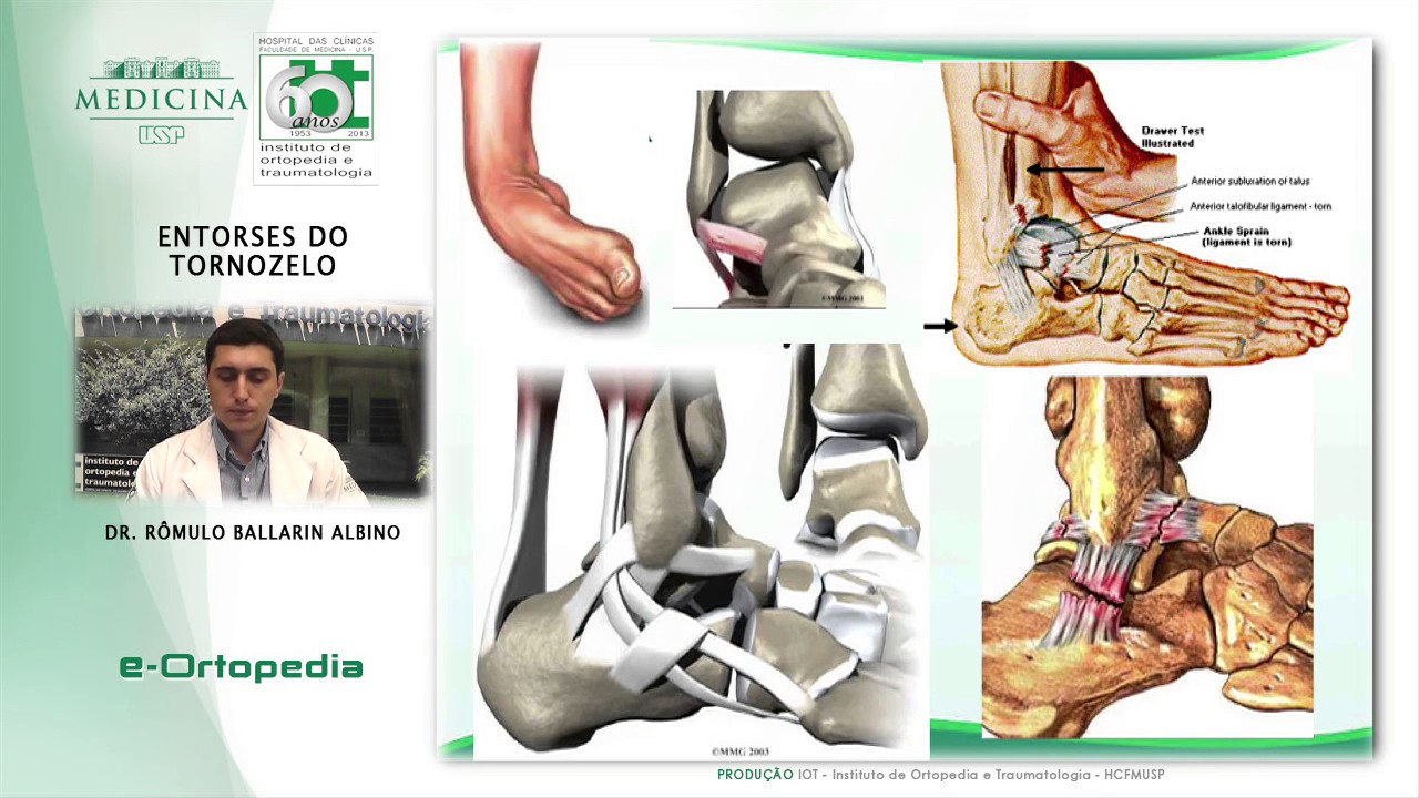 Entorses do Tornozelo - Dr. Rômulo Ballarin Albino